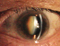 catarata ocular