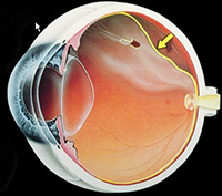 Retinal Detachment